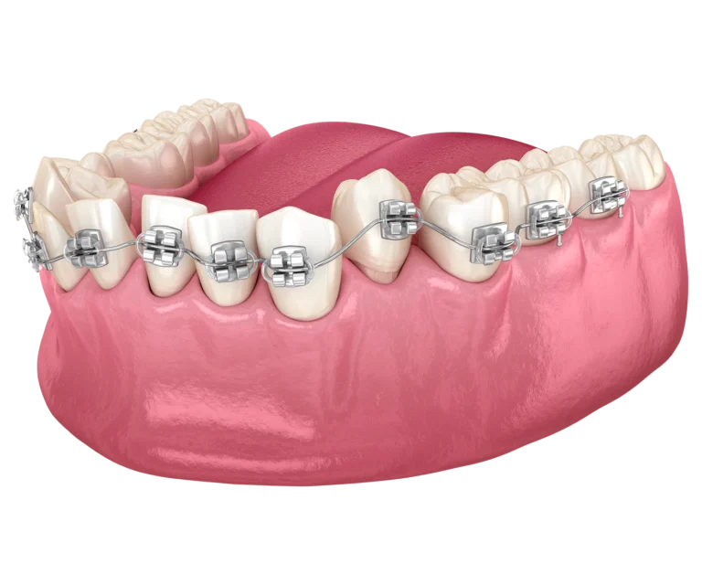 Frenillos Met licos Cl nica Dental Santa Blanca